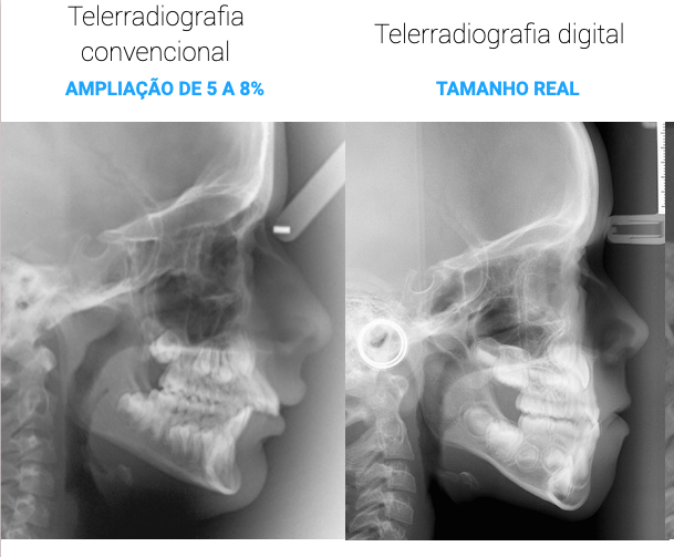 Ampliação radiográfica cefalometria.png