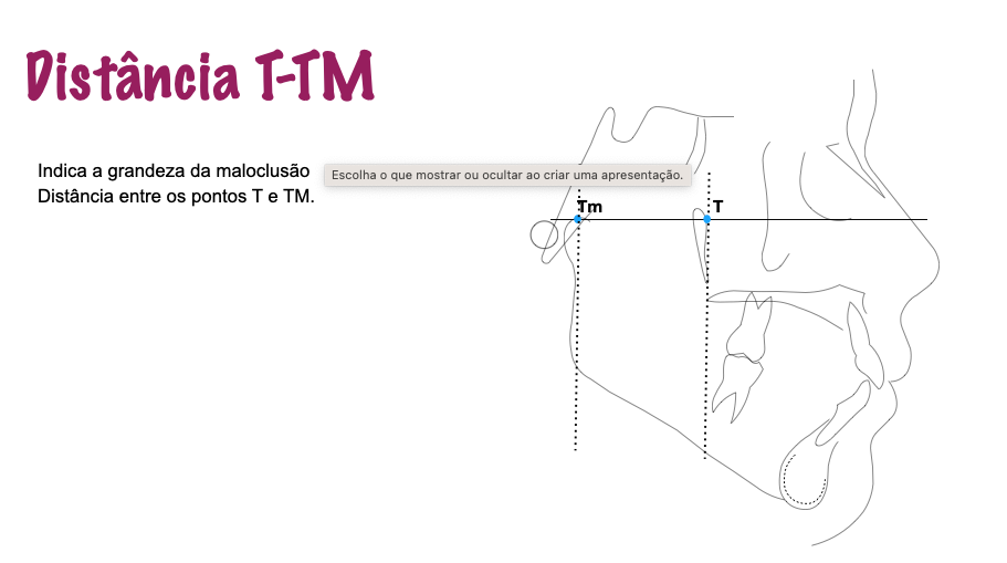 T-Tm - cefalometria
